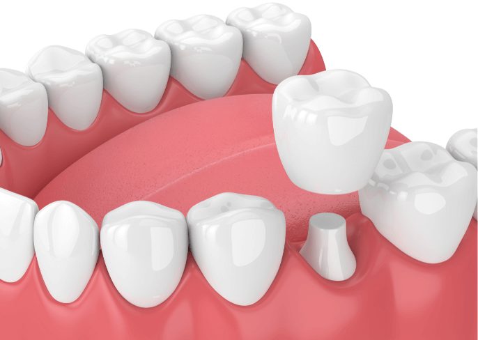 Dental Treatment Options for a Cracked Tooth - Columbia Advanced Dental  Studio Columbia Maryland