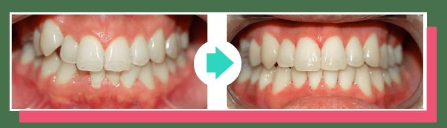 Before & After ClearCorrect Aligners